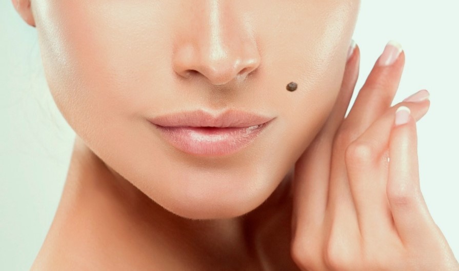 Чому не варто видаляти папіломи самостійно вдома