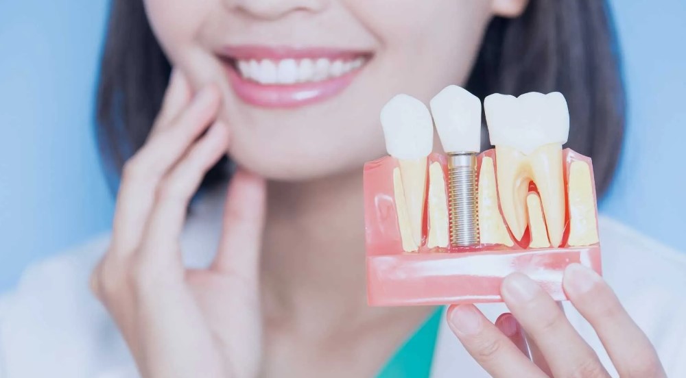 Що таке імплантація зубів і коли вона необхідна